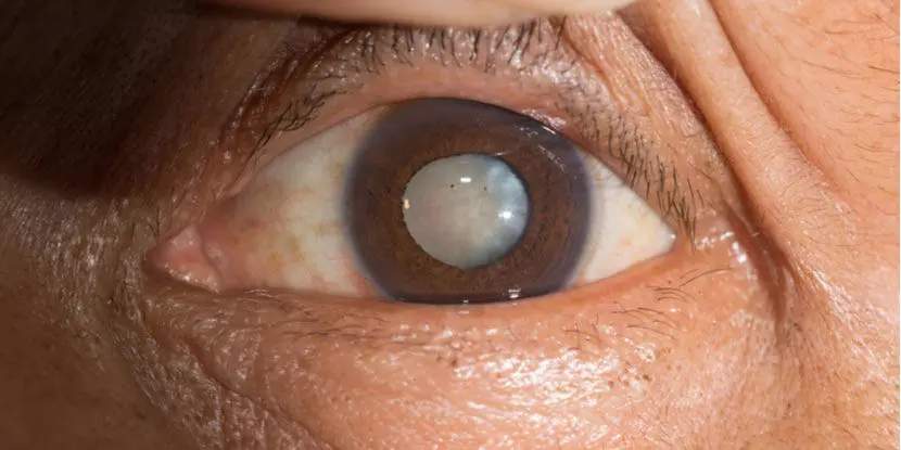 cataract surgery