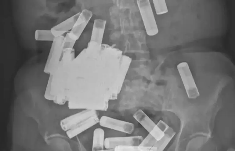 X-ray reveals 55 ingested batteries stuck in a womans GI tract  Picture courtesy: Irish Medical Journal