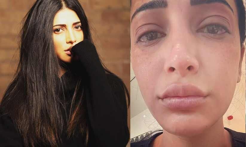 Actress Shruti Haasan with swollen face;  What happened to the fans?  Shruti Haasan New shocking photo posts