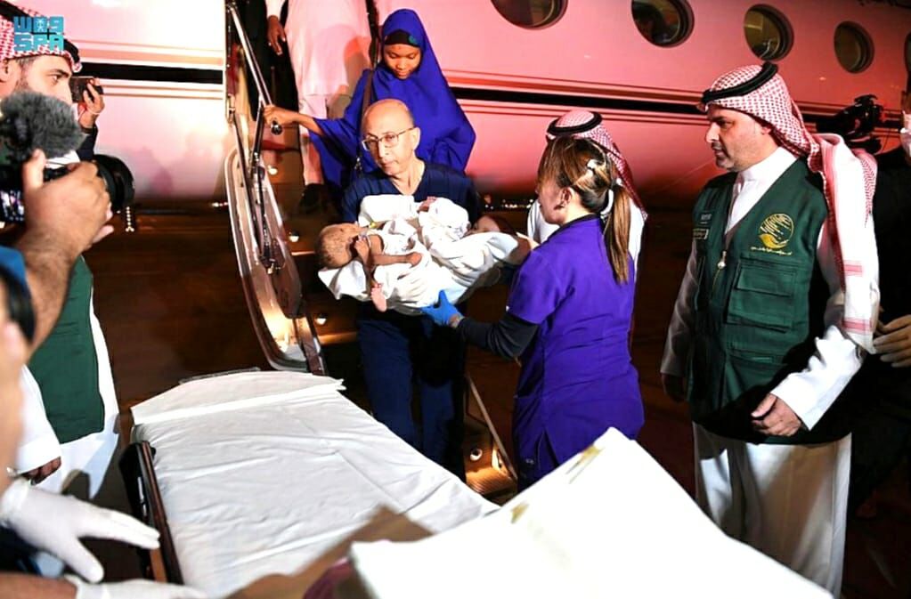 Nigerian Siamese in Riyadh looking for possibility of ‘hybridisation’ Nigerian Siamese Twins arrive in Riyadh to be separated