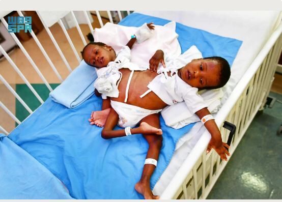 Tanzanian Siamese Twins Set for Surgical Separation at King Abdullah Children’s Specialist Hospital